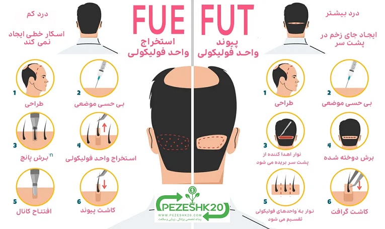 کاشت مو